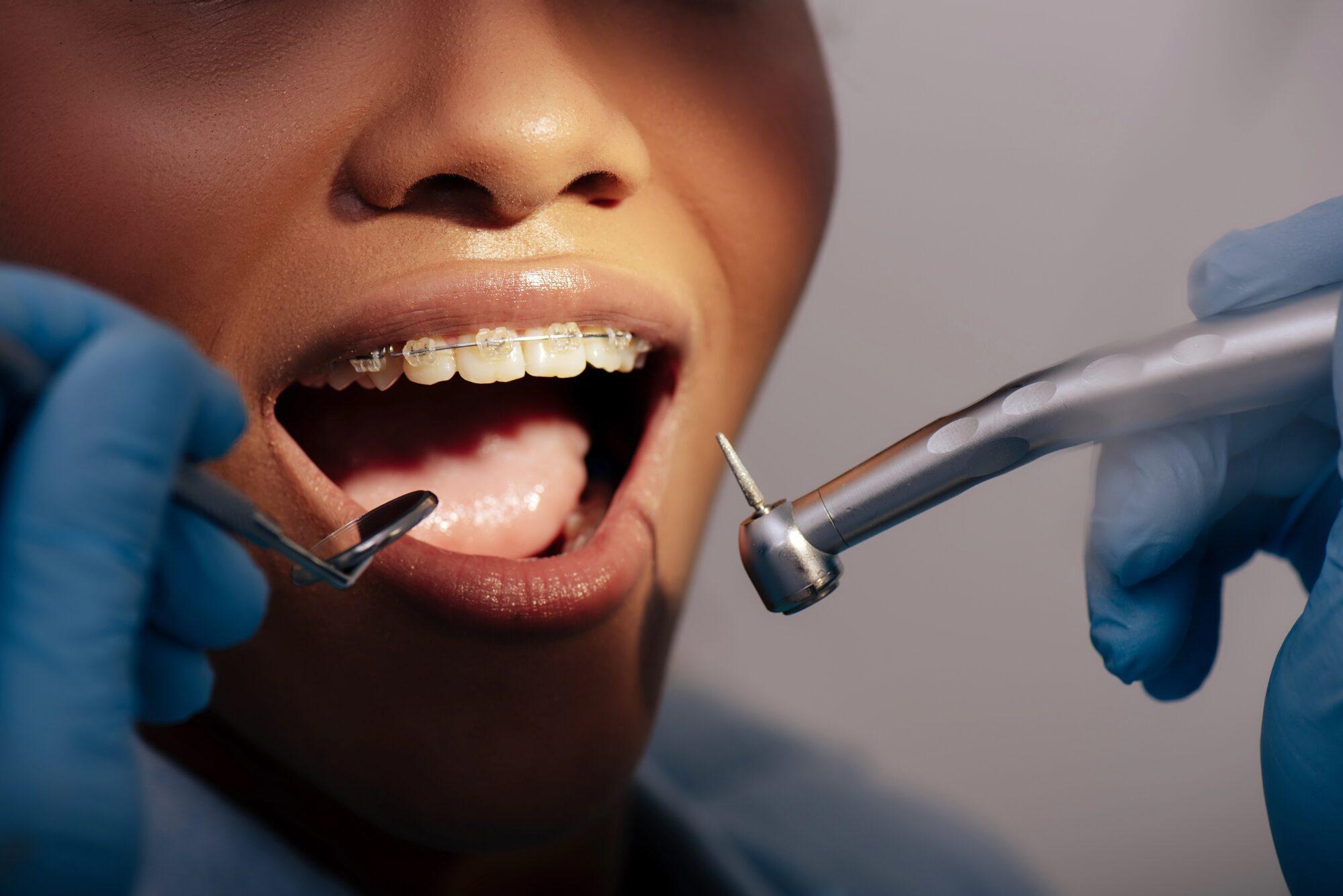 Kieferorthopädische Untersuchung mit Keramikbrackets